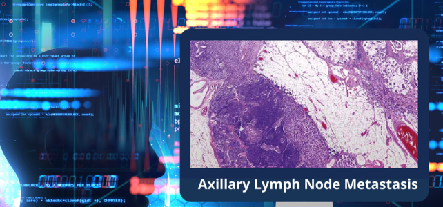 AI Can Help Diagnose Breast Cancer Axillary Lymph Node Metastasis